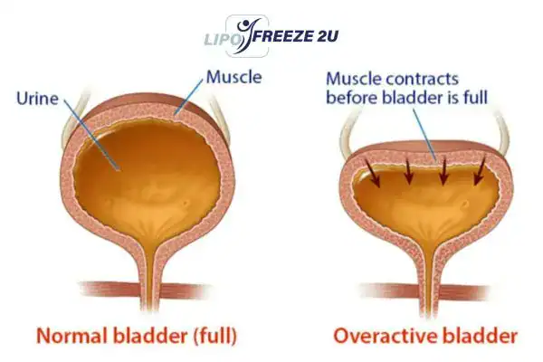 diagram of overactive bladder treatment Chester