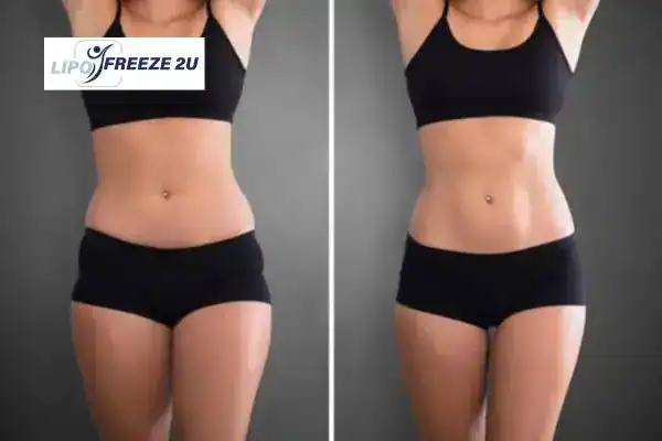 How Can LIPO FREEZE 2U Support Your Post-Pregnancy Body Recovery Chester?