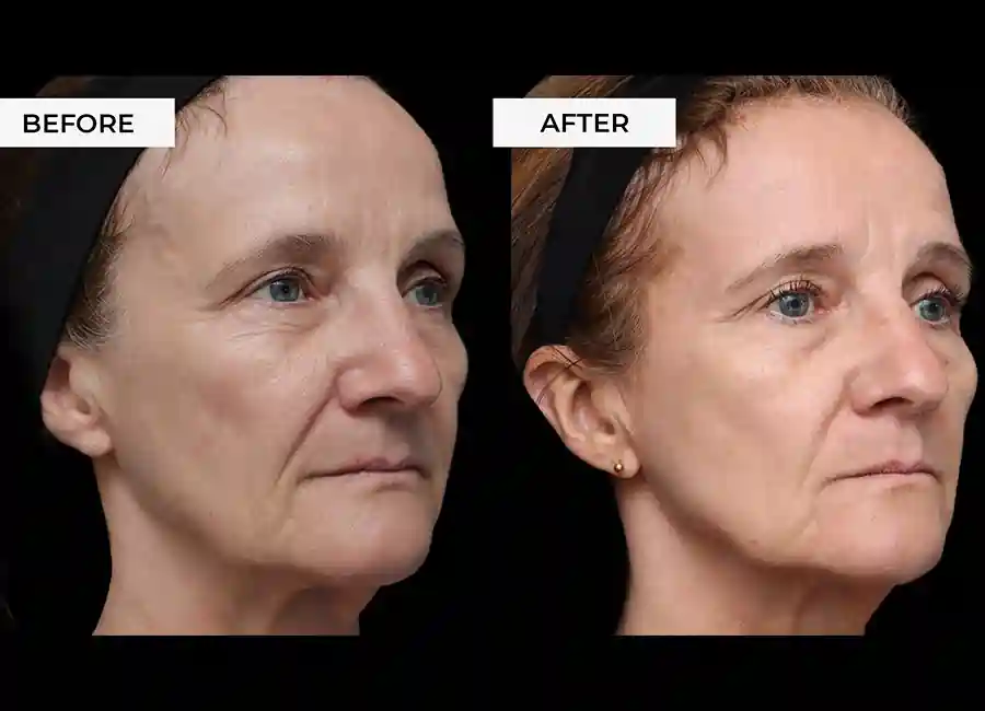 How Many RF Microneedling Sessions Will You Need to See a Difference Chester?