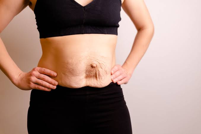 Is Surgery Really the Only Way to Repair Diastasis Recti Chester?