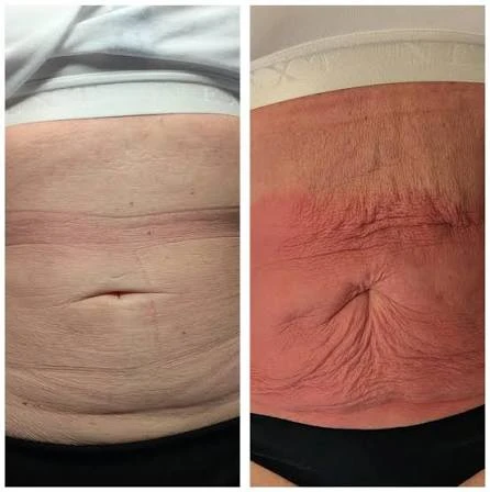 How Does RF Microneedling Improve Crepey, Thin and Uneven Skin Texture Chester?