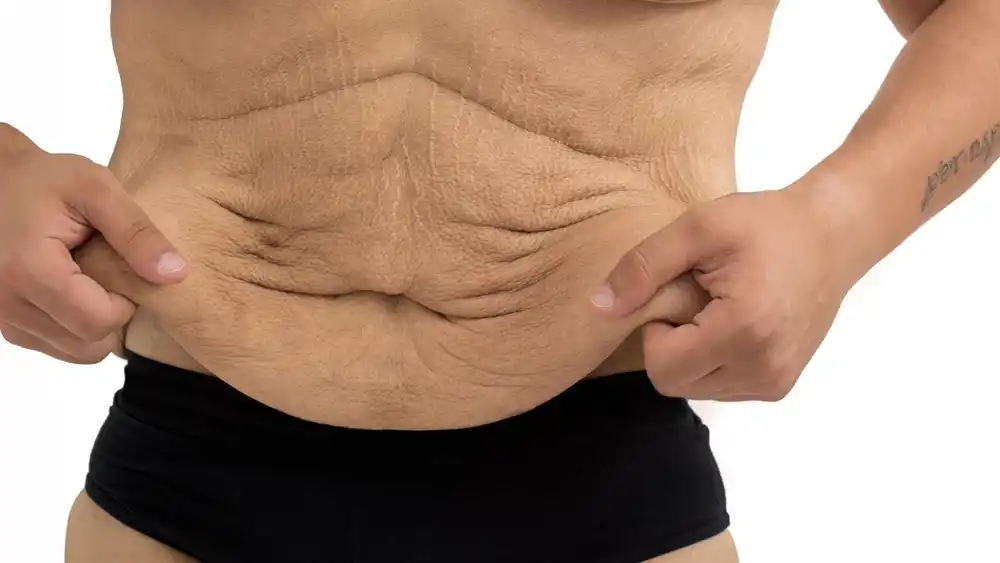 Why Does Weight Loss Medication Leave Some People With Loose or Sagging Skin Chester?